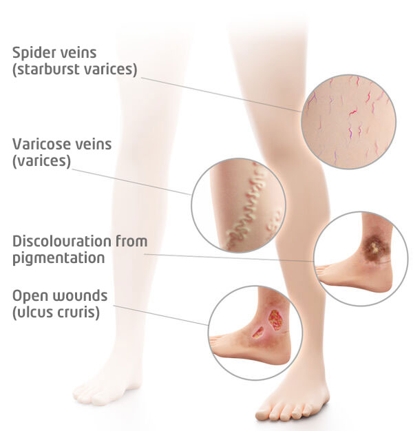 Chronic Venous Insufficiency - The Foot Force Podiatry