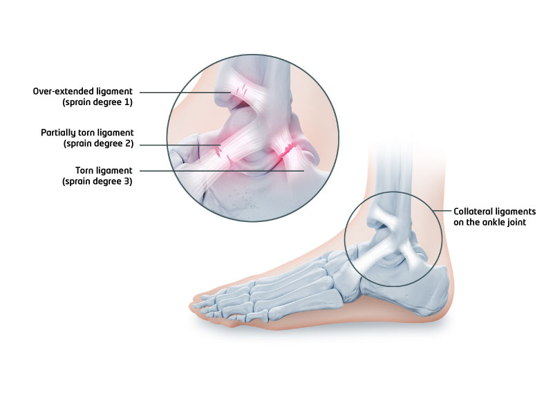 Ankle joint distortion - Bort